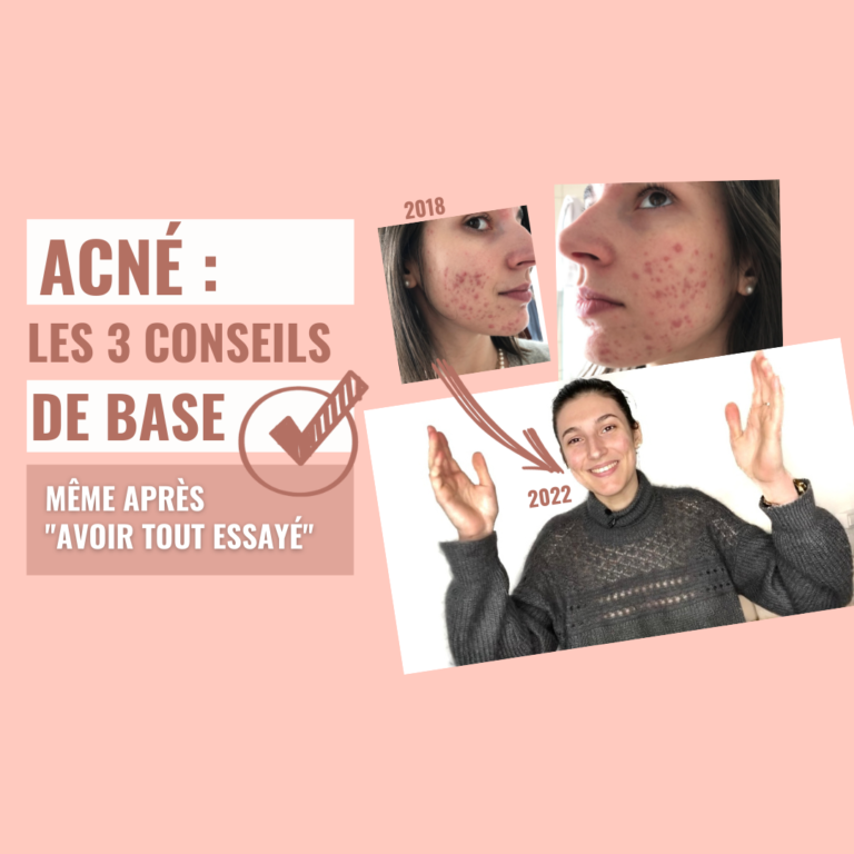 Acné : les 3 conseils fondamentaux de base !