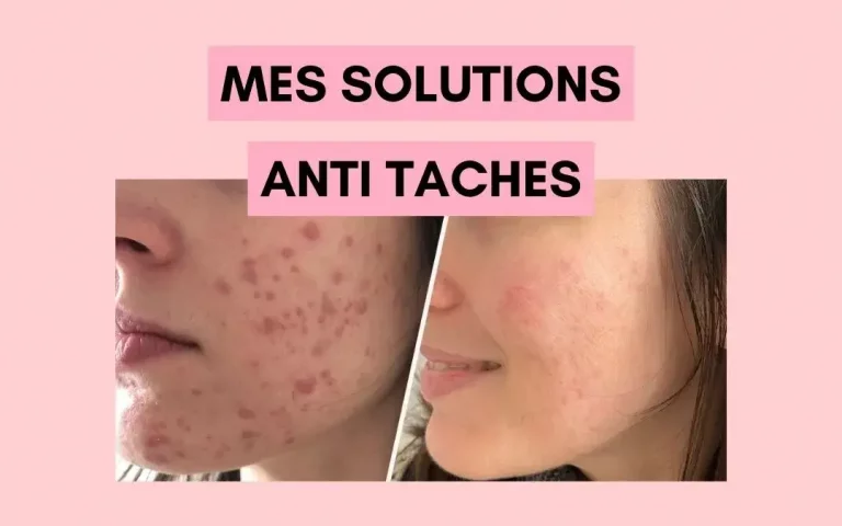 Comment réduire naturellement ses taches (cicatrices acné) ?