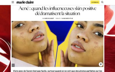 Acné : les influenceuses skin positive dédramatisent