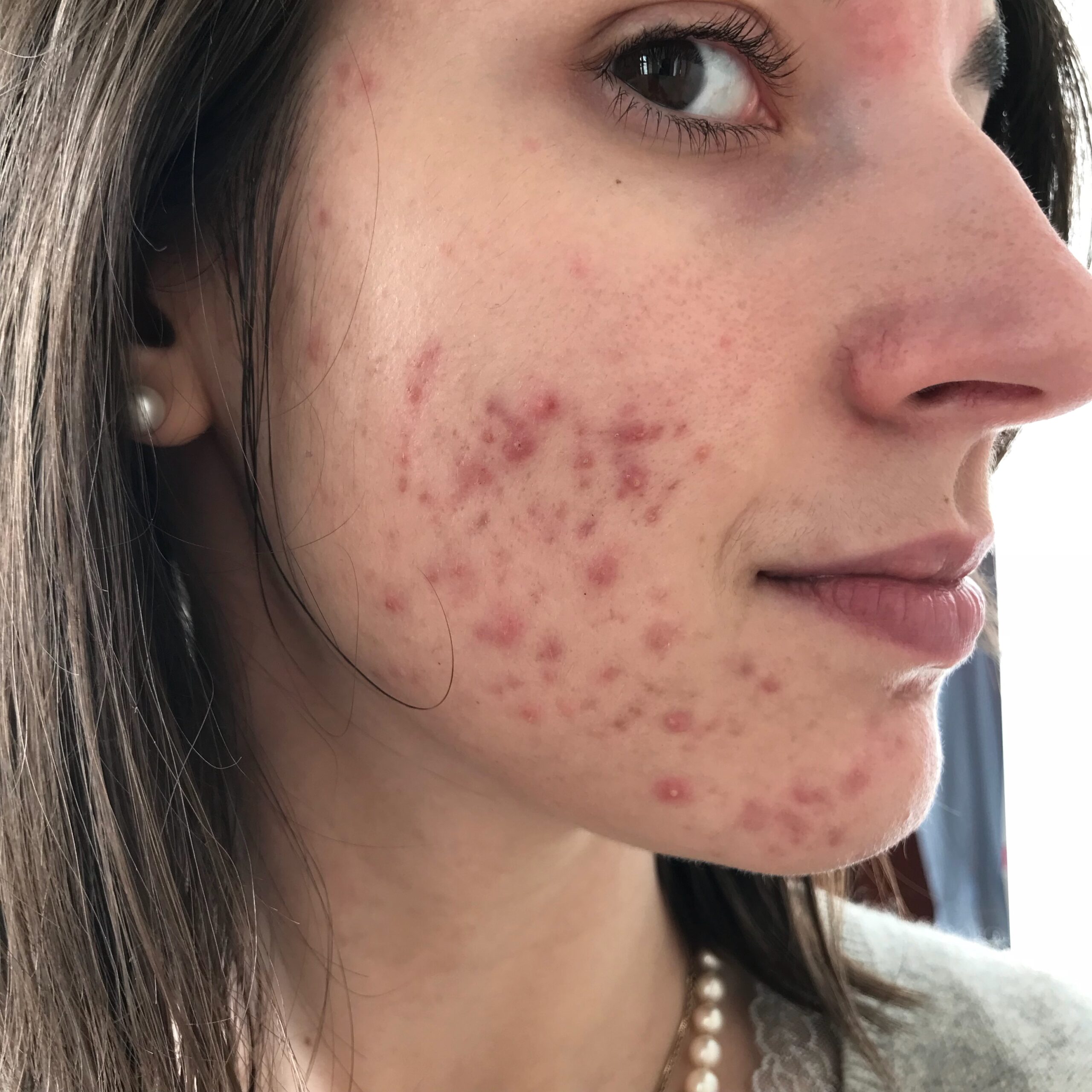 Anne avant, peau acnéique